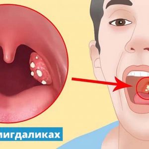 Казеозні пробки та хронічний тонзиліт: чому вони з’являються і коли потрібне промивання мигдаликів